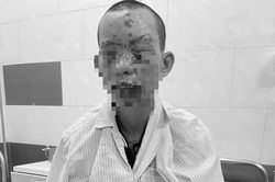Mất thị lực, sém toàn thân vì tai nạn sử dụng điện thoại khi đang sạc
