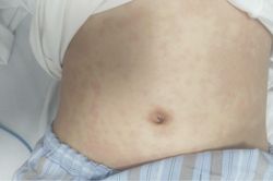 Tổn thương phổi nặng sau 2 tuần khỏi Covid-19