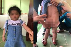 Khởi tố dì ruột dùng cán chổi đánh cháu gái 4 tuổi nhập viện