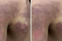 Nghệ An xác nhận vụ giáo viên đánh tím vai học sinh lớp 3