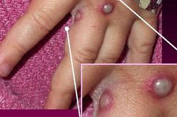 Thêm nhiều quốc gia châu Âu phát hiện các trường hợp mắc bệnh đậu mùa khỉ