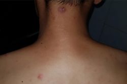 Việt Nam muốn xóa sổ bệnh phong cùi