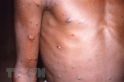 Thêm Thụy Sỹ, Israel có ca đầu tiên, bệnh đậu mùa khỉ đang lây lan khắp châu Âu
