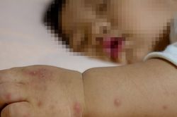 Bệnh tay chân miệng gia tăng, cha mẹ cần làm gì chăm sóc trẻ?