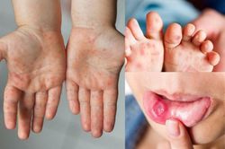 Tăng cường phòng, chống dịch bệnh tay chân miệng