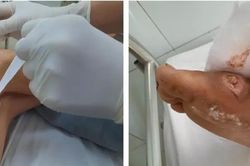 Bệnh nhi 9 tuổi mắc vi khuẩn ăn thịt người