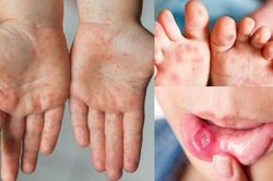 Số trẻ mắc tay chân miệng ở Hà Nội tăng vọt trong một tuần qua