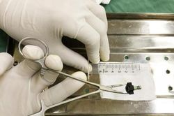 Dị vật lọt vào vùng kín bé gái 8 tuổi