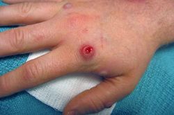 WHO điều tra nghi vấn virus đậu mùa khỉ có khả năng lây lan qua đường tình dục