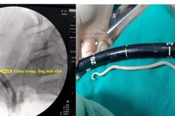 Bé gái đau bụng buồn nôn, bác sĩ gắp ra con giun dài 20cm