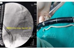Gắp giun đũa gần 20 cm trong ống mật chủ của bé gái 11 tuổi