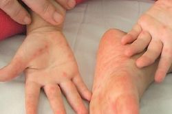 Bệnh tay - chân - miệng và những nhầm lẫn tai hại