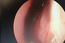 Đỉa khu trú 3 ngày trong mũi bé 10 tuổi