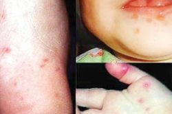 Y tế - Sức khỏe Tin tức y tế Chú ý dịch bệnh tay chân miệng