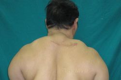 Căn bệnh hiếm gặp khiến người phụ nữ tăng cân mất kiểm soát