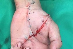 Nối bàn tay bị đứt lìa ngay trong đêm cho bệnh nhân