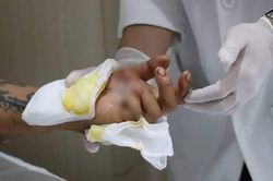 Chạy đua 'cứu sống' bàn tay gần đứt lìa của người đàn ông 32 tuổi