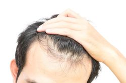 Phương pháp mới điều trị rụng tóc