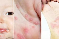 Khuyến cáo phòng, chống bệnh tay - chân - miệng