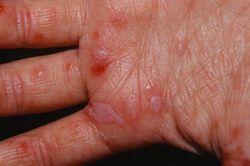 Phân biệt nốt phát ban tay chân miệng với bệnh khác