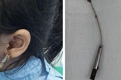 Kinh hãi bé gái 6 tuổi bị que lấy ráy tai đâm xuyên vào tai giữa, bài học cho nhiều gia đình!