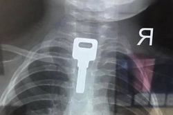 Bị giật mình, bé trai 2 tuổi nuốt chiếc chìa khóa 'khủng' vào thực quản