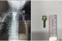 Đang chơi với chìa khóa, bé trai 2 tuổi bất ngờ nuốt luôn vào thực quản, nhập viện khẩn
