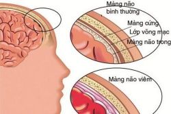 Cảnh giác với bệnh viêm màng não
