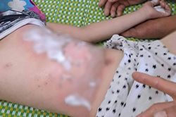 Lên mái tôn quét rác, bé gái 10 tuổi bị phóng điện bỏng nặng toàn thân