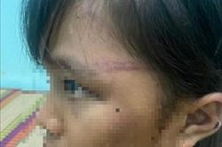 Xác minh việc bé gái nghi bị bạo hành ở Bình Phước