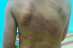 Bình Phước: Bé gái 7 tuổi nghi bị bạo hành với nhiều vết bầm tím hằn khắp cơ thể