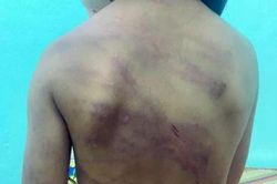 Bé gái 7 tuổi có nhiều vết thương trên người, nghi bị bạo hành