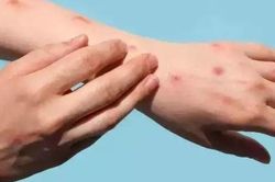 Nhật phát hiện thêm ca mắc đậu mùa khỉ mới