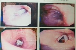 Gắp thành công dị vật là xương ống heo ra khỏi phế quản người bệnh