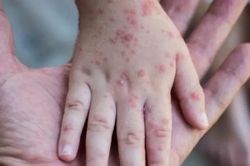 Hà Nội hướng dẫn chẩn đoán, điều trị và phòng bệnh đậu mùa khỉ