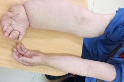 Hình ảnh cánh tay kỳ lạ của người phụ nữ mắc ung thư