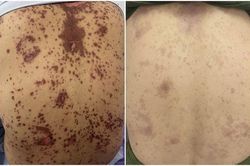Người phụ nữ loét toàn thân sau khi tự ý dùng thuốc