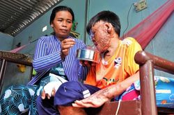 Liều mình cứu mẹ nuôi khỏi đám cháy, cậu bé bị biến dạng cơ thể, trải qua nhiều cuộc phẫu thuật đau đớn