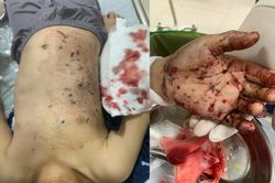 Đồ chơi chứa pin phát nổ, bé trai 10 tuổi nhập viện với đa chấn thương do dị vật găm vào