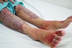 Uống thực phẩm chức năng để thải độc, một phụ nữ bỏng rộp toàn thân, suýt tử vong