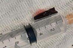 Lấy mảnh gỗ dài 3cm nằm trong cổ bệnh nhân suốt... 4 tháng