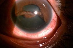 Suýt mù mắt do vòi xịt nước văng trúng