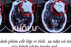 Thường xuyên mệt mỏi, đau đầu, mắt nhìn mờ, thai phụ rơi vào hôn mê, đe dọa tính mạng