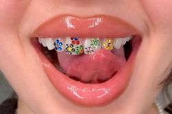 Bất chấp nguy hiểm để chạy theo mốt gắn đá quý vào răng trên TikTok