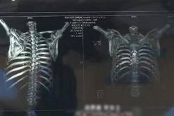 Đau lưng sau khi đi massage, cô gái phát hiện chuyện kinh dị