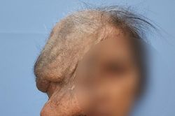 Phẫu thuật cho cụ bà bị khối u quá lớn che hết khuôn mặt, ăn vào mắt, xương sọ