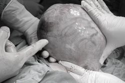 Phẫu thuật cắt bỏ khối u xơ nặng 3,5kg cho người phụ nữ dân tộc Dao