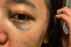 Nữ ca sĩ công khai loạt ảnh mặt mũi bầm tím, tố bị chồng hành hung