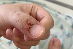 Tay mẹ rớm máu vì con sốt co giật, bác sĩ cảnh báo sai lầm thường gặp