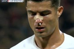 Ronaldo đổ máu trong trận thắng CH Czech